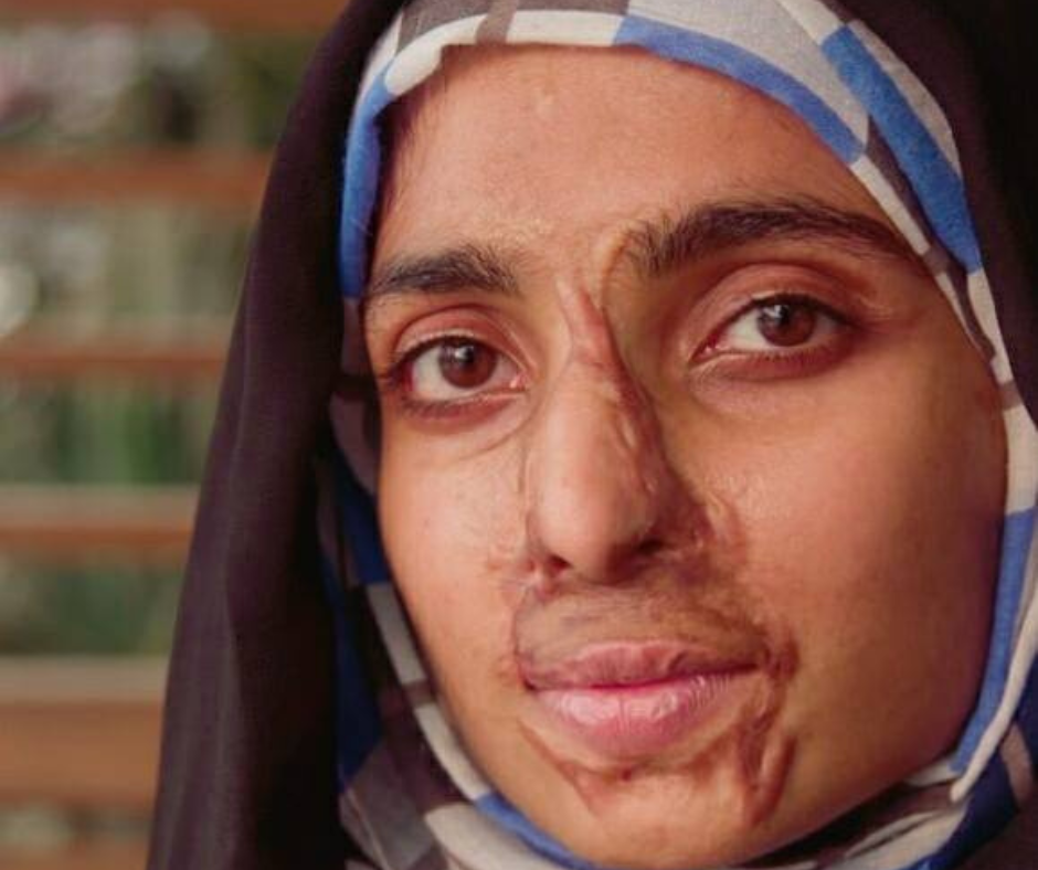 Meet Suman Ali, Acid Attack Survivor in Pakistan